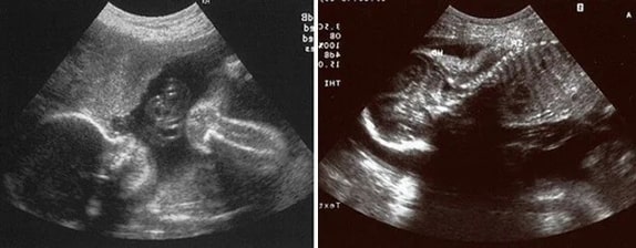 24 Haftalık Gebelik Ultrason Görüntüleri