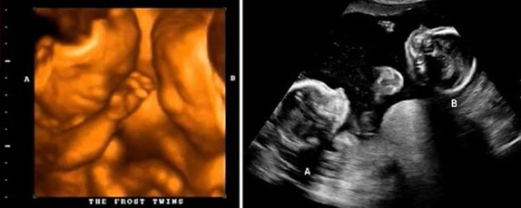 24 Haftalık İkiz Gebelik Ultrason Görüntüleri