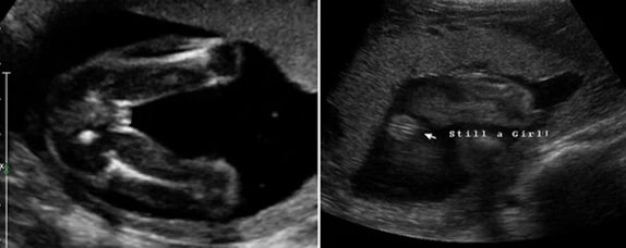 24 Haftalık Kız Bebek Ultrason Görüntüsü