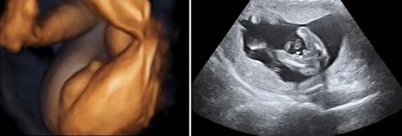 25 Haftalık Erkek Bebek Ultrason Görüntüsü