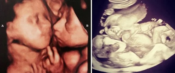 25 Haftalık İkiz Gebelik Ultrason Görüntüleri