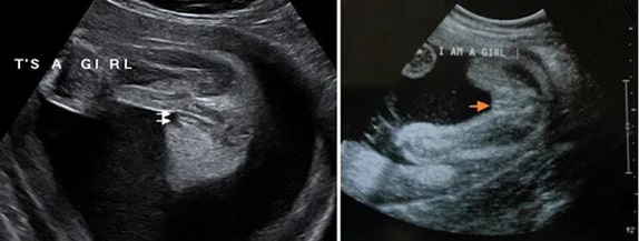 25 Haftalık Kız Bebek Ultrason Görüntüsü