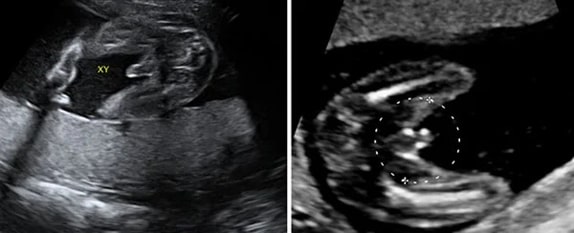 26 Haftalık Erkek Bebek Ultrason Görüntüsü