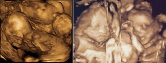 26 Haftalık İkiz Gebelik Ultrason Görüntüleri