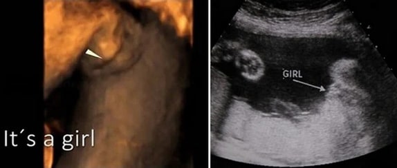 26 Haftalık Kız Bebek Ultrason Görüntüsü 26 Haftalık Kız Bebek Ultrason Görüntüsü