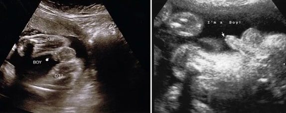 27 Haftalık Erkek Bebek Ultrason Görüntüsü