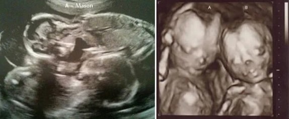 27 Haftalık İkiz Gebelik Ultrason Görüntüleri