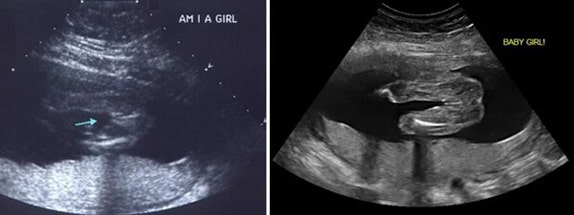 27 Haftalık Kız Bebek Ultrason Görüntüsü
