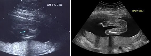 27 Haftalık Kız Bebek Ultrason Görüntüsü 27 Haftalık Kız Bebek Ultrason Görüntüsü