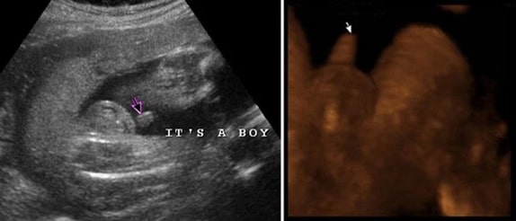 28 Haftalık Erkek Bebek Ultrason Görüntüsü