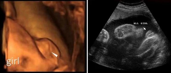 28 Haftalık Kız Bebek Ultrason Görüntüsü