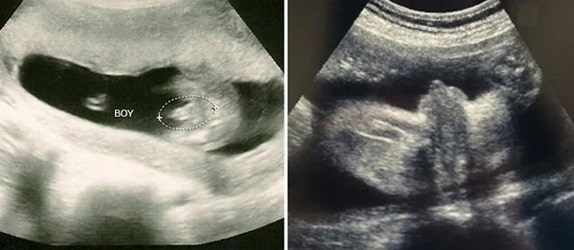 29 Haftalık Erkek Bebek Ultrason Görüntüsü