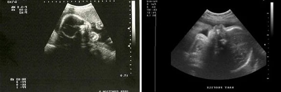 29 Haftalık Gebelik Ultrason Görüntüleri