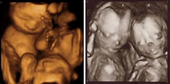 29 Haftalık İkiz Gebelik Ultrason Görüntüleri