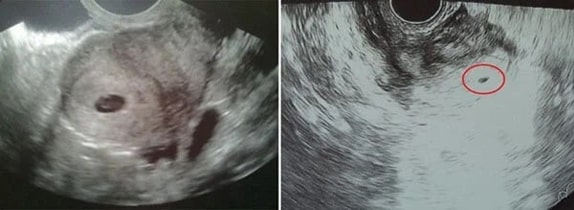 3 Haftalık Bebek Ultrason Görüntüsü
