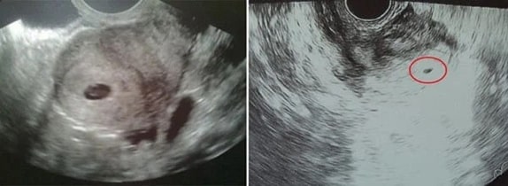 3 Haftalık Bebek Ultrason Görüntüsü 3 Haftalık Bebek Ultrason Görüntüsü
