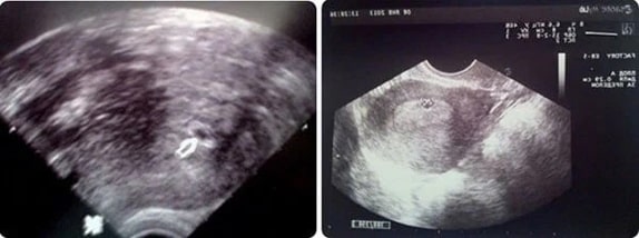 3 Haftalık Gebelik Ultrason Görüntüleri 3 Haftalık Gebelik Ultrason Görüntüleri