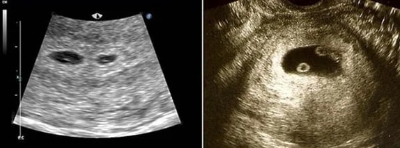 3 Haftalık İkiz Gebelik Ultrason Görüntüleri 3 Haftalık İkiz Gebelik Ultrason Görüntüleri