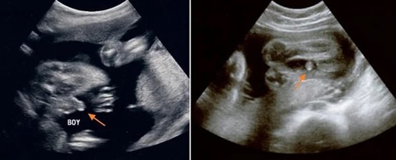 30 Haftalık Erkek Bebek Ultrason Görüntüsü