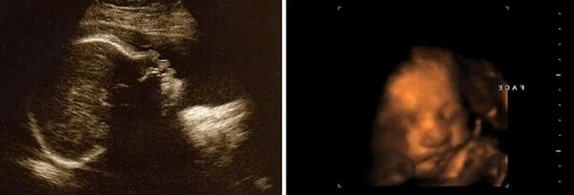 30 Haftalık Gebelik Ultrason Görüntüleri