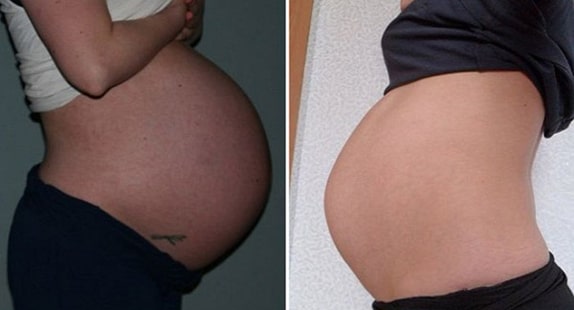 30 Haftalık Hamile Göbeği