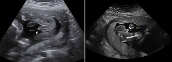 31 Haftalık Erkek Bebek Ultrason Görüntüsü
