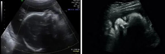 31 Haftalık Gebelik Ultrason Görüntüleri