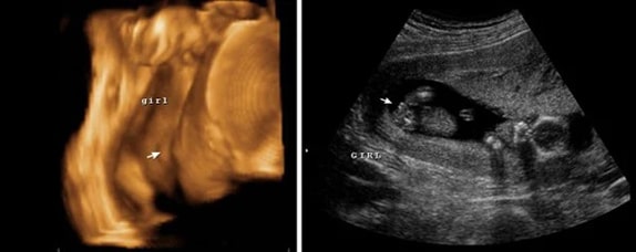 31 Haftalık Kız Bebek Ultrason Görüntüsü