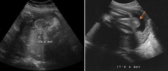 32 Haftalık Erkek Bebek Ultrason Görüntüsü
