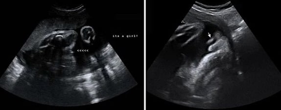 32 Haftalık Kız Bebek Ultrason Görüntüsü