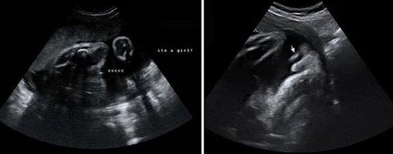 32 Haftalık Kız Bebek Ultrason Görüntüsü 32 Haftalık Kız Bebek Ultrason Görüntüsü