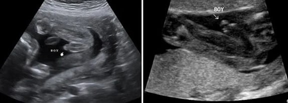 33 Haftalık Erkek Bebek Ultrason Görüntüsü