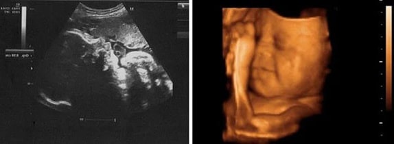 33 Haftalık Gebelik Ultrason Görüntüleri