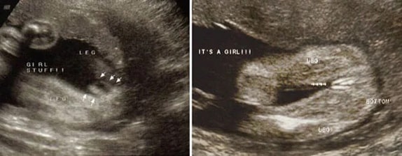 33 Haftalık Kız Bebek Ultrason Görüntüsü