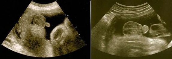 34 Haftalık Erkek Bebek Ultrason Görüntüsü