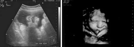 34 Haftalık Gebelik Ultrason Görüntüleri