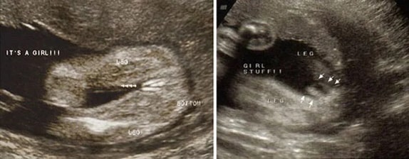 35 Haftalık Kız Bebek Ultrason Görüntüsü