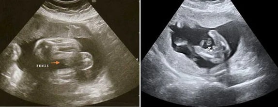 36 Haftalık Erkek Bebek Ultrason Görüntüsü