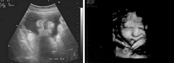 36 Haftalık Gebelik Ultrason Görüntüleri