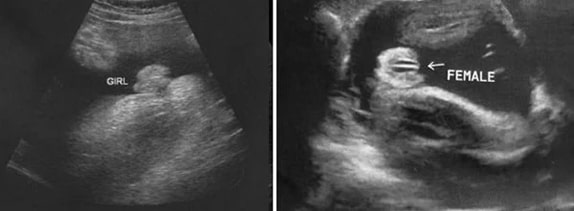 36 Haftalık Kız Bebek Ultrason Görüntüsü