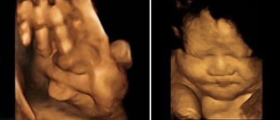 37 Haftalık Bebek Ultrason Görüntüsü