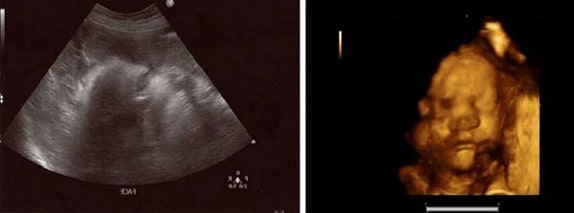 37 Haftalık Gebelik Ultrason Görüntüleri