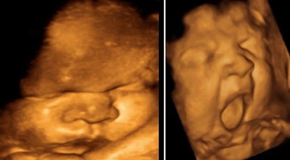 38 Haftalık Bebek Ultrason Görüntüsü