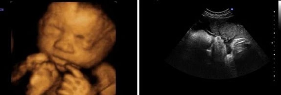 38 Haftalık Gebelik Ultrason Görüntüleri