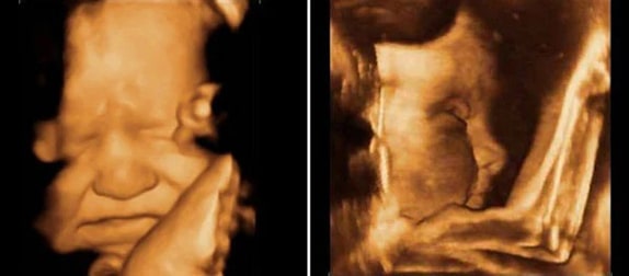39 Haftalık Bebek Ultrason Görüntüsü