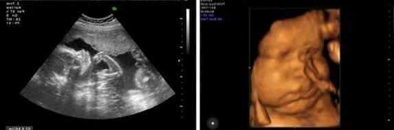 39 Haftalık Gebelik Ultrason Görüntüleri