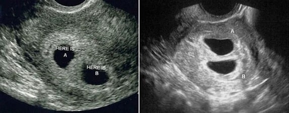 4 Haftalık İkiz Gebelik Ultrason Görüntüleri 4 Haftalık İkiz Gebelik Ultrason Görüntüleri