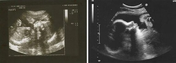 40 Haftalık Gebelik Ultrason Görüntüleri