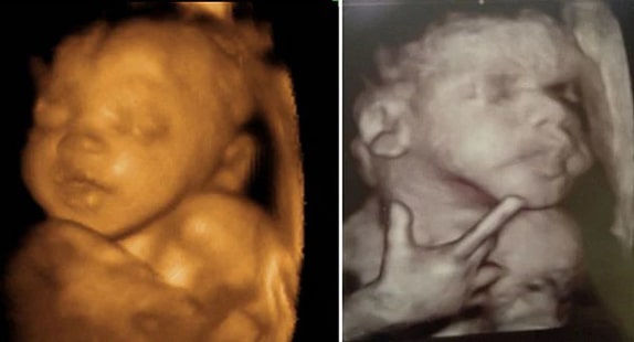 41 Haftalık Bebek Ultrason Görüntüsü