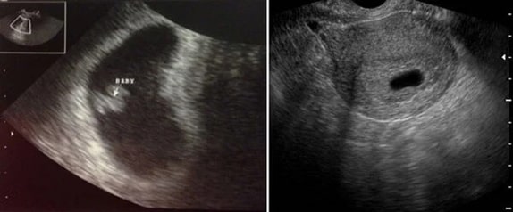 5 Haftalık Bebek Ultrason Görüntüsü 5 Haftalık Bebek Ultrason Görüntüsü
